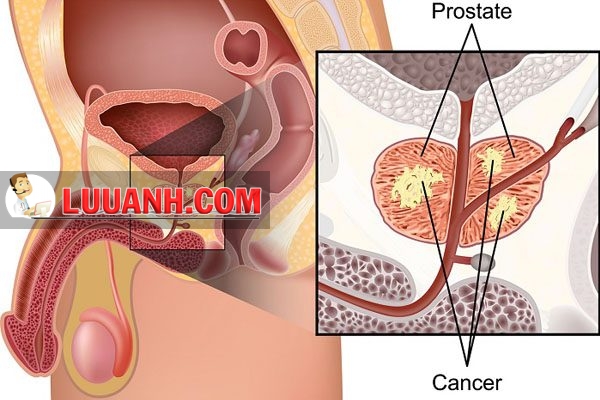 Các tế bào ung thư trong tuyến tiền liệt