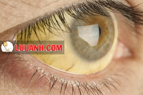 Màu mắt của bệnh nhân bị Viêm gan A