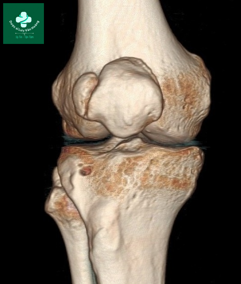 Bipartite patella 9