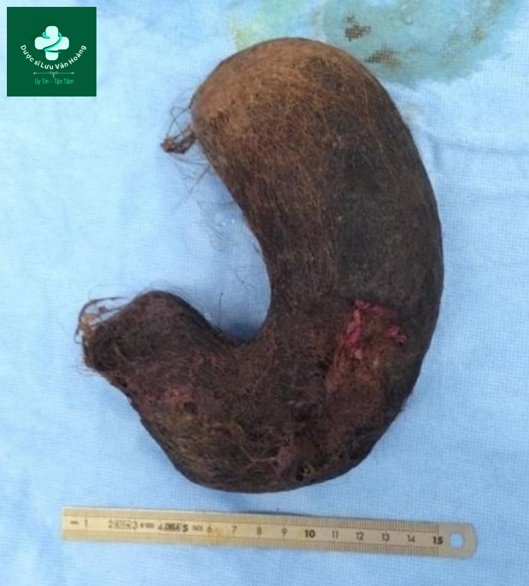 Hình ảnh của trichobezoar.