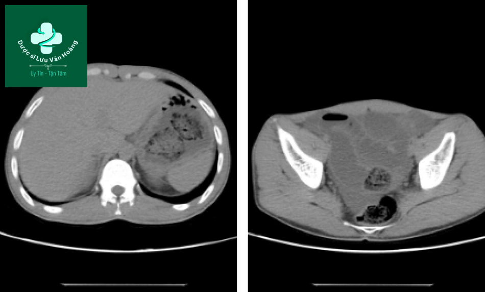 Hình ảnh CT chưa tiêm thuốc cản quang: dạ dày giãn với hai cấu trúc có chứa khí, hình oval, được cho là bã thức ăn. Các quai ruột non giãn vừa phải và trong lòng hồi tràng có chứa cấu trúc tương tự. Dịch tự do ổ bụng.