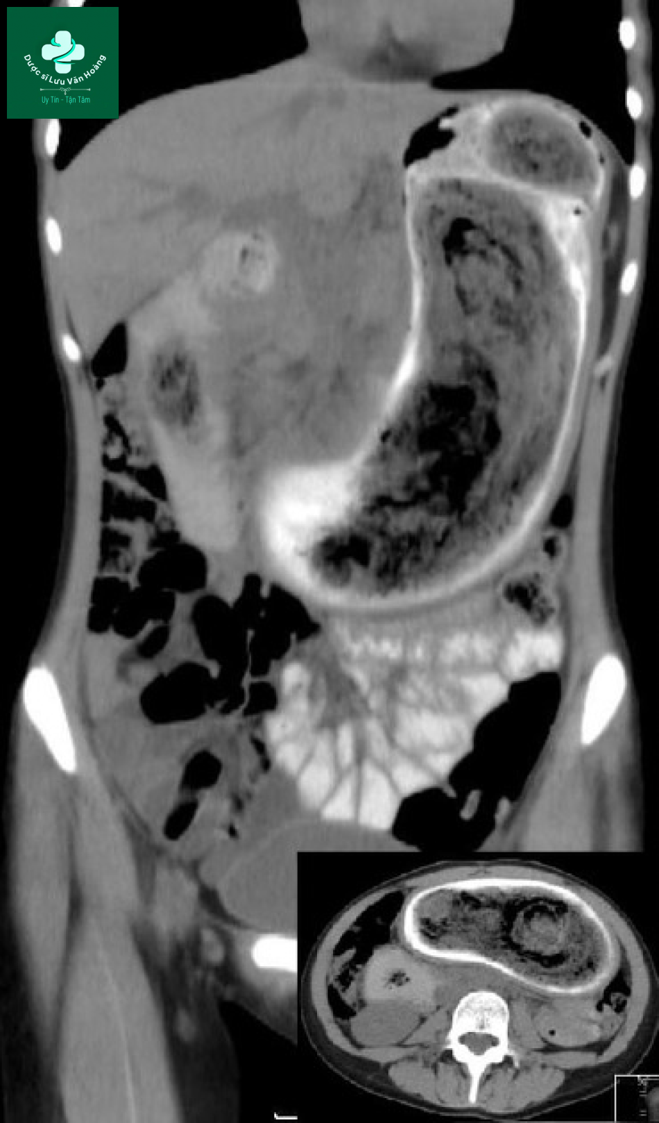 Hình ảnh CT cho thấy một khối lớn có đậm độ không đồng nhất trong dạ dày, phù hợp với tóc và bã thức ăn