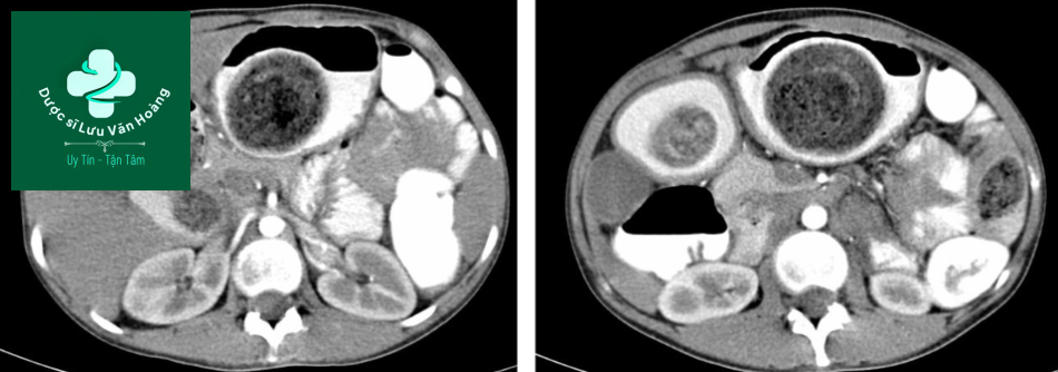 Hình ảnh CT cho thấy một khối lớn không đồng nhất có chứa khí bên trong trong lòng dạ dày, kéo dài qua môn vị đến khúc 2 tá tràng. Có khối tương tự trong hồi tràng ở vùng hạ sườn và mạn sườn trái. 