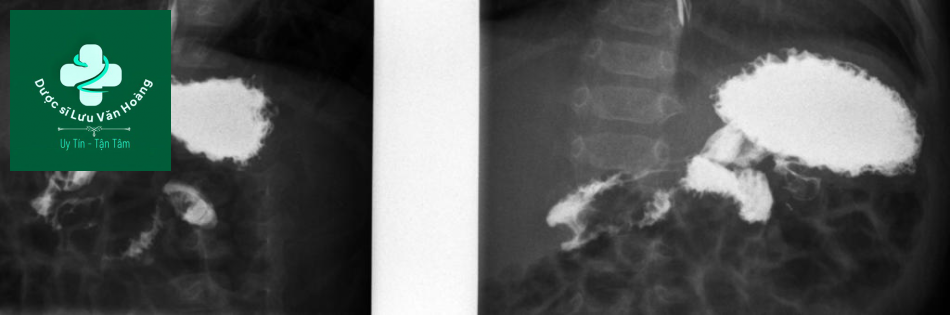 Hình 1: vị trí bình thường của góc Treitz. Góc tá hỗng tràng nằm ở bên trái cột sống, ngang mức hành tá tràng trên phim thẳng và ở phía sau trên phim nghiêng.