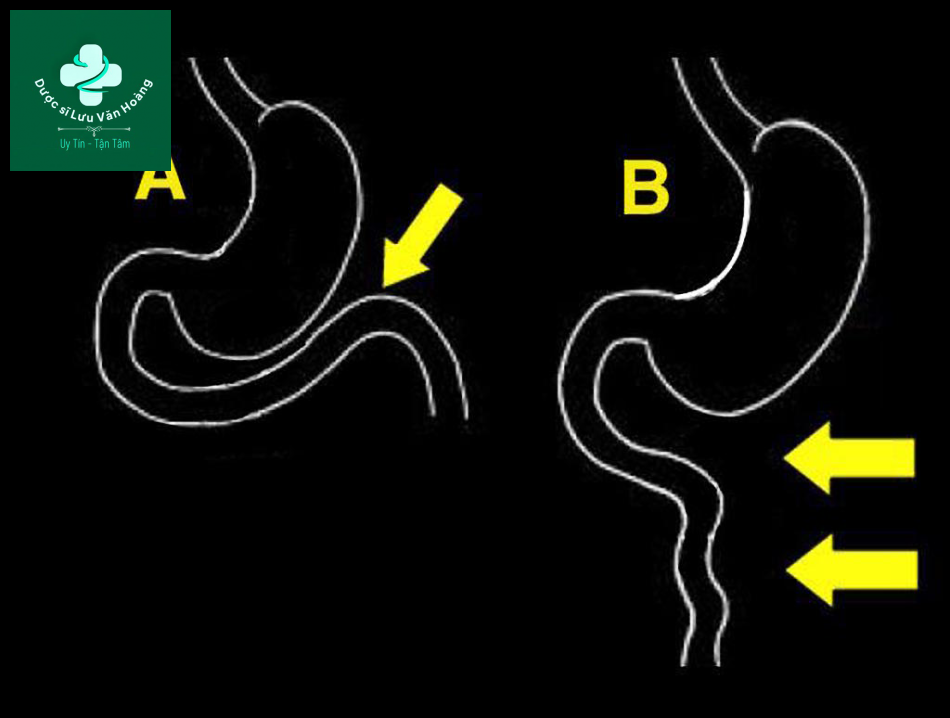 A: vị trí bình thường của góc tá hỗng tràng. B: hình minh họa của ruột xoay bất toàn.