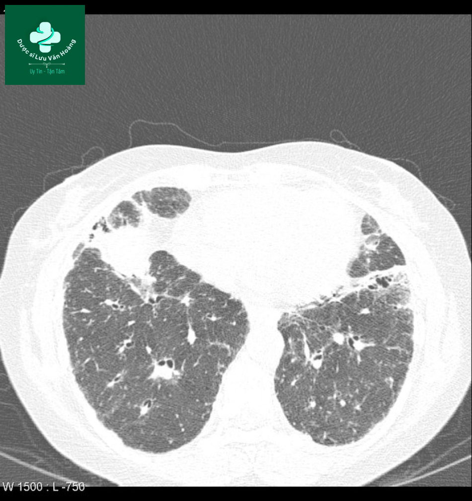 sarcoidosis 10