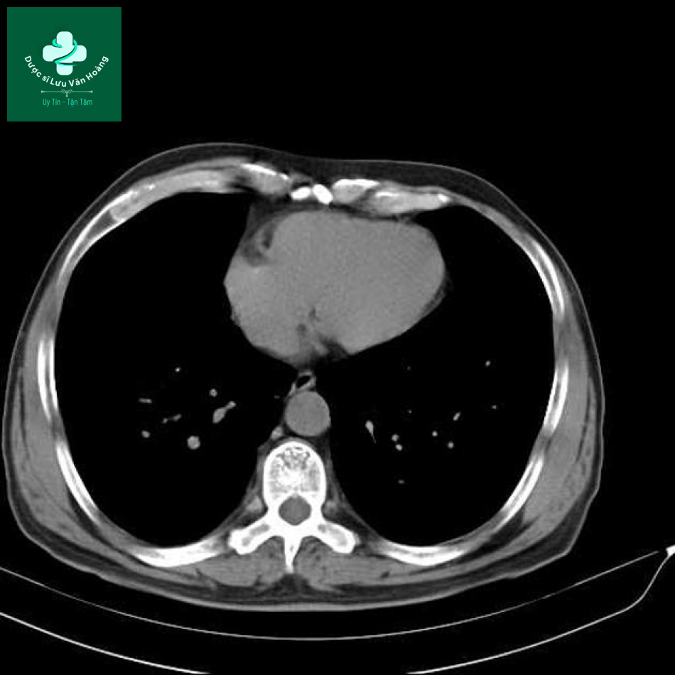 sarcoidosis 19