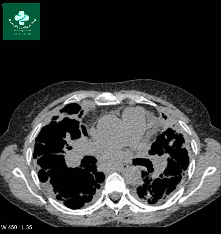 sarcoidosis 8