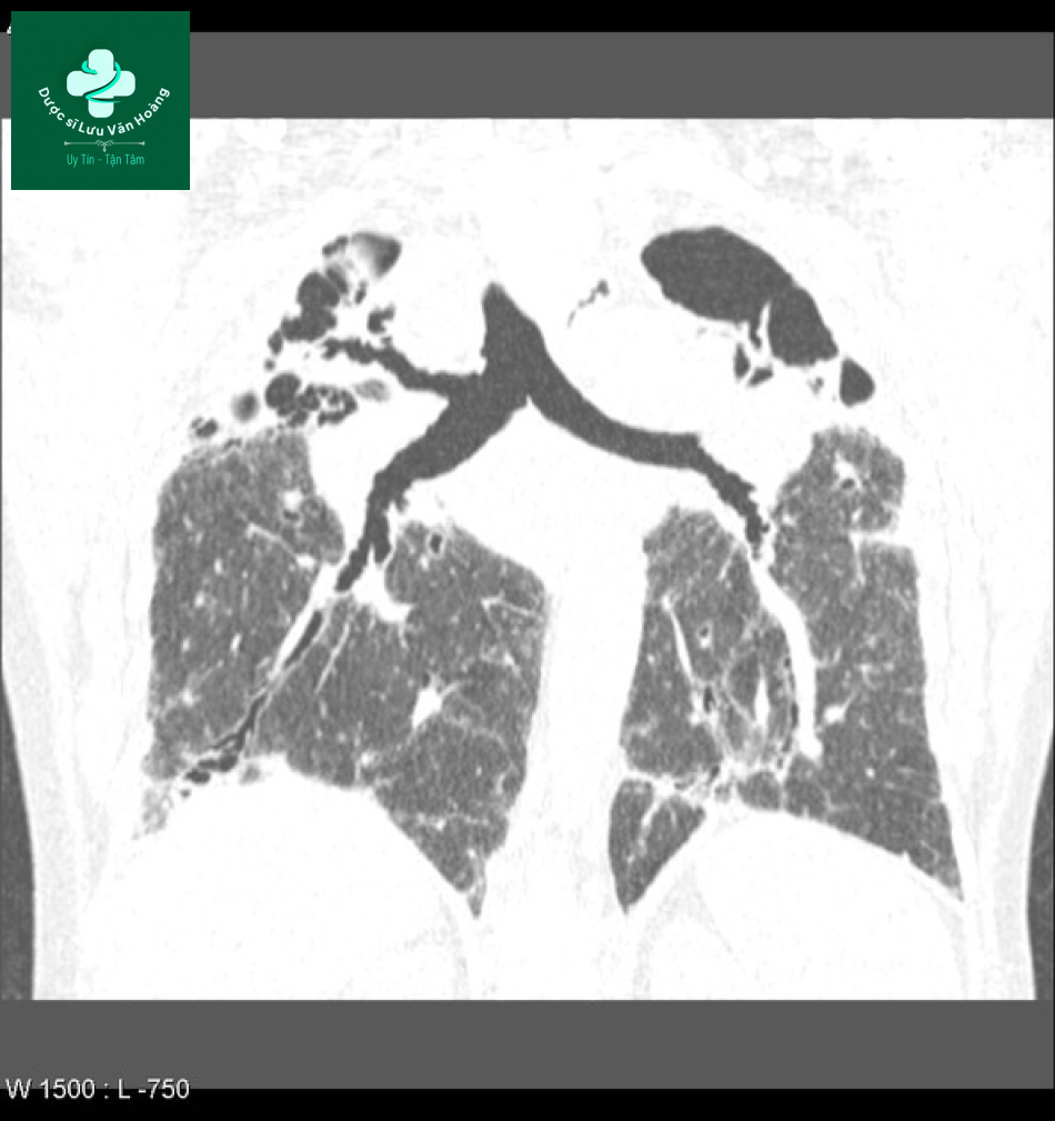 sarcoidosis 9