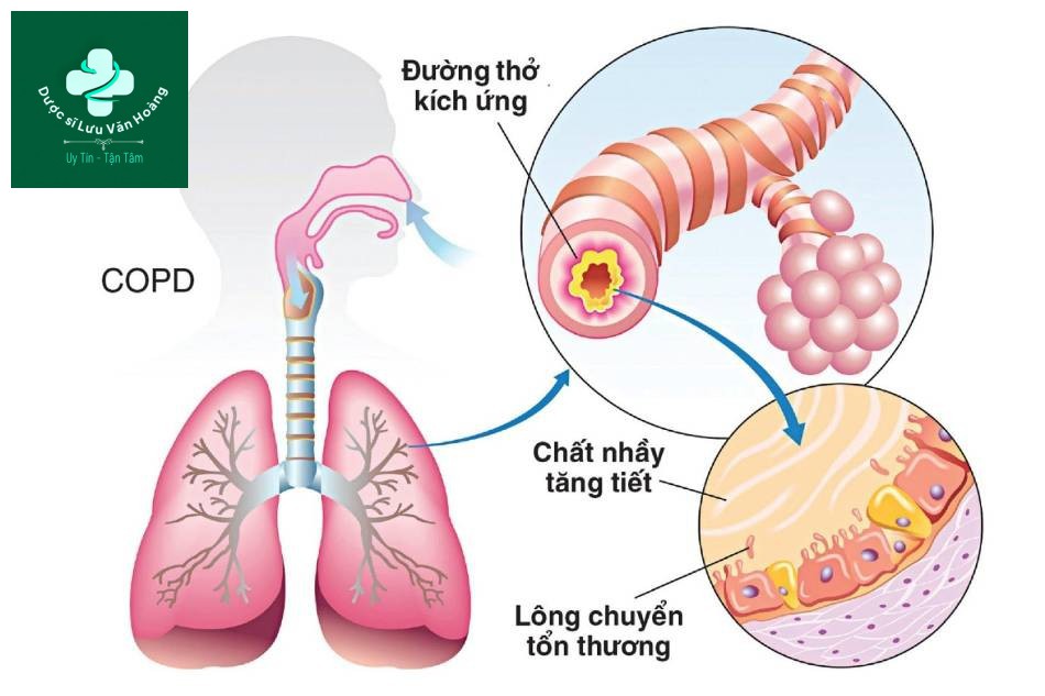 Triệu chứng bệnh phổi thời kỳ cuối Hiểu rõ hơn về căn bệnh nguy hiểm này