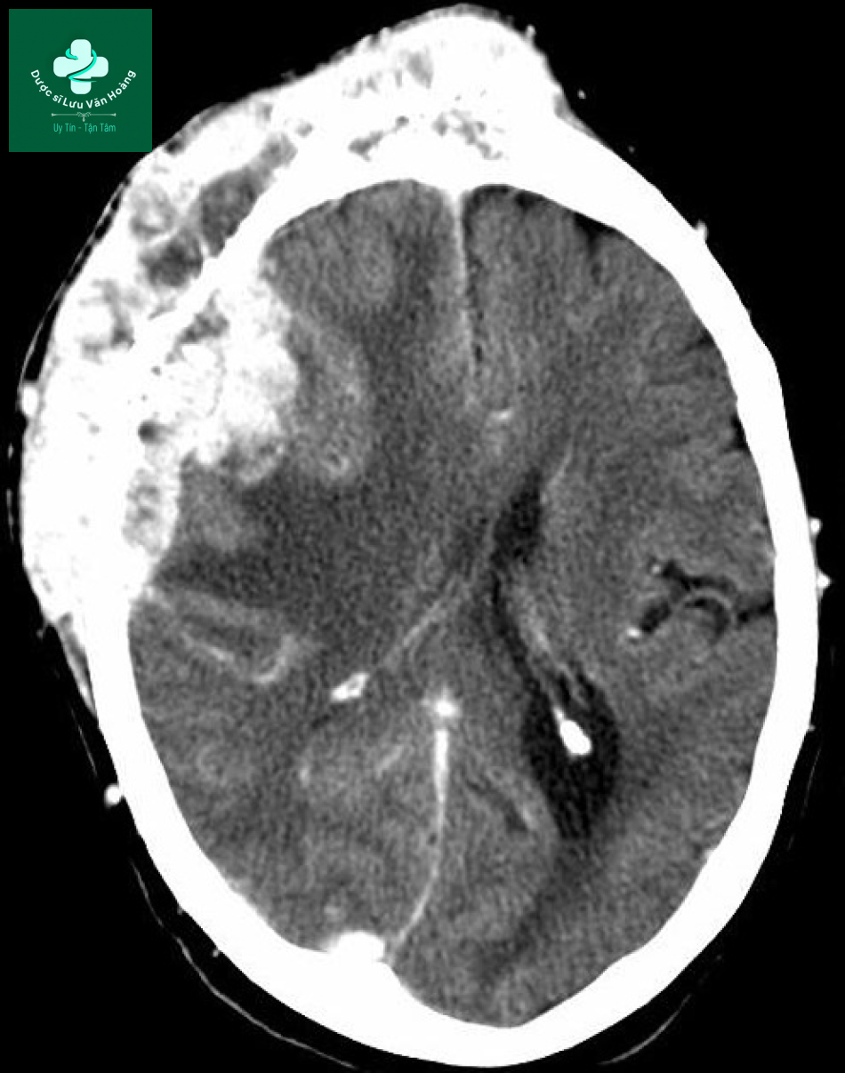 Follicular thyroid cancer 4