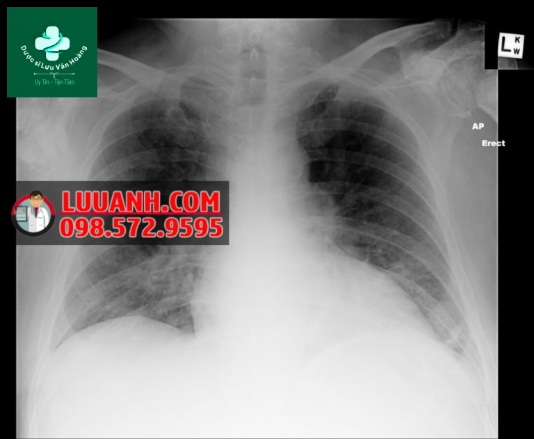 loan duong xuong o benh nhan suy than man tinh 6 e1657535552440