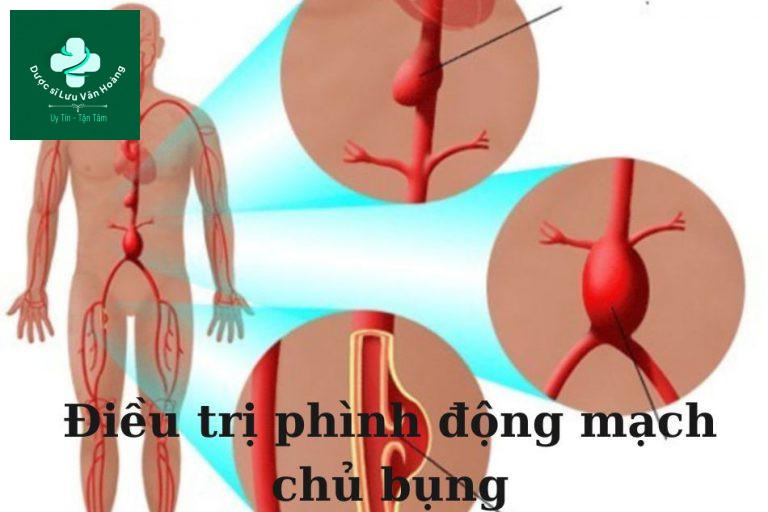 Điều trị phình động mạch chủ bụng