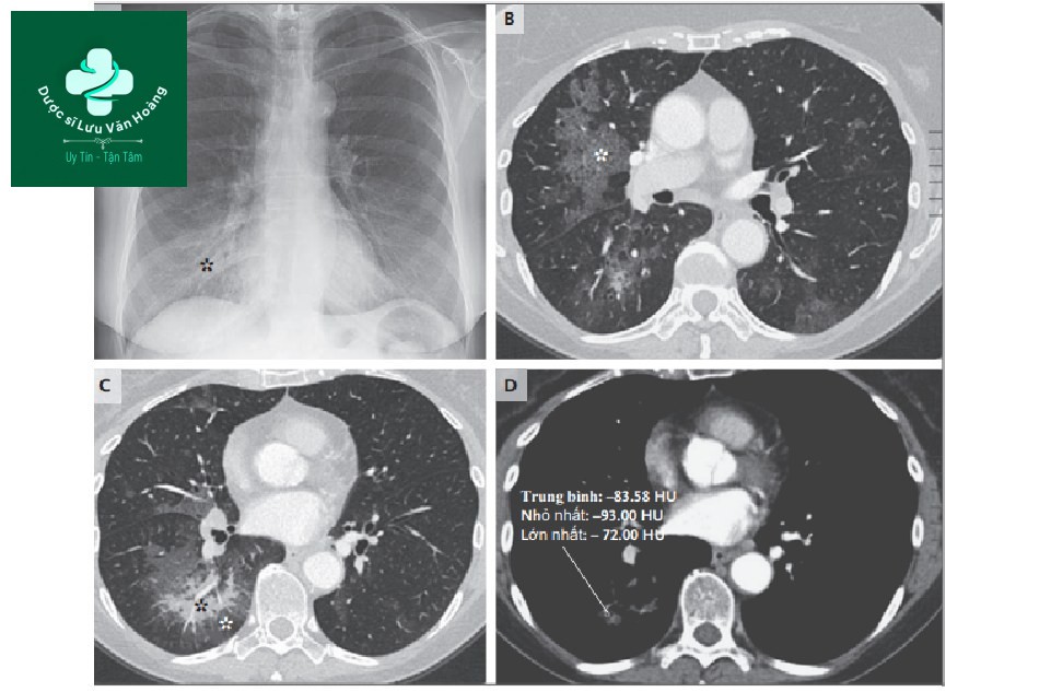 Hình 1. Cận lâm sàng hình ảnh Xquang và CT ngực