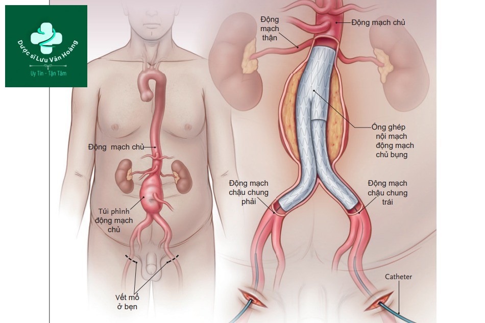 Hình 2. Can thiệp nội mạch trong phình động mạch chủ bụng dưới thận.