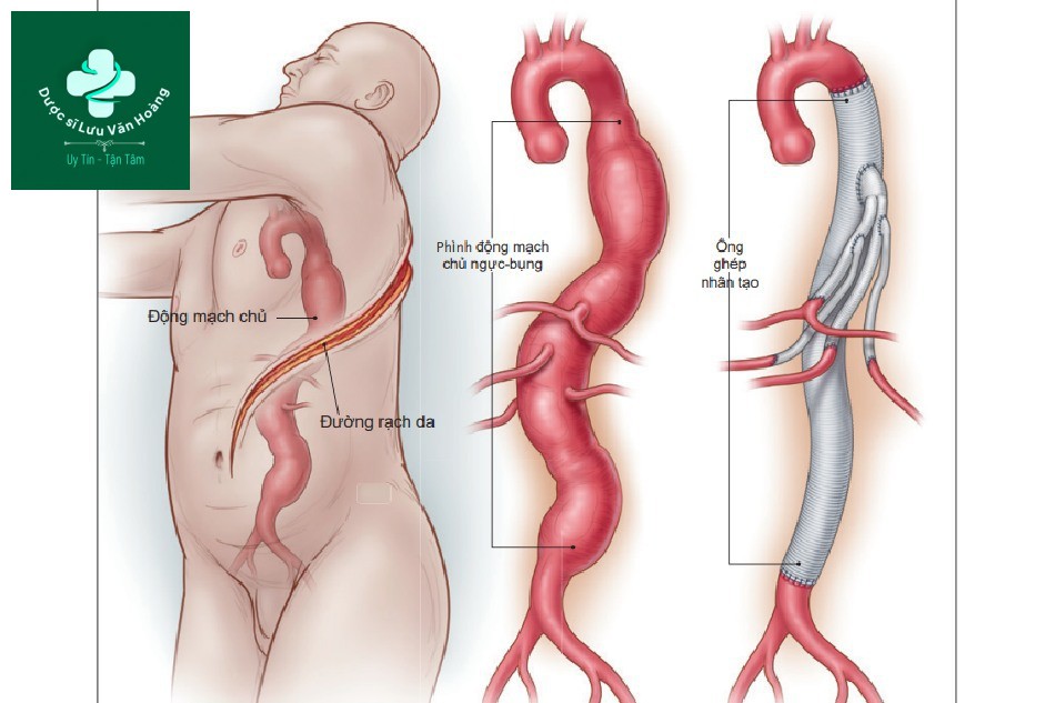 Hình 4. Can thiệp mổ mở phức hợp phình động mạch chủ ngực-bụng