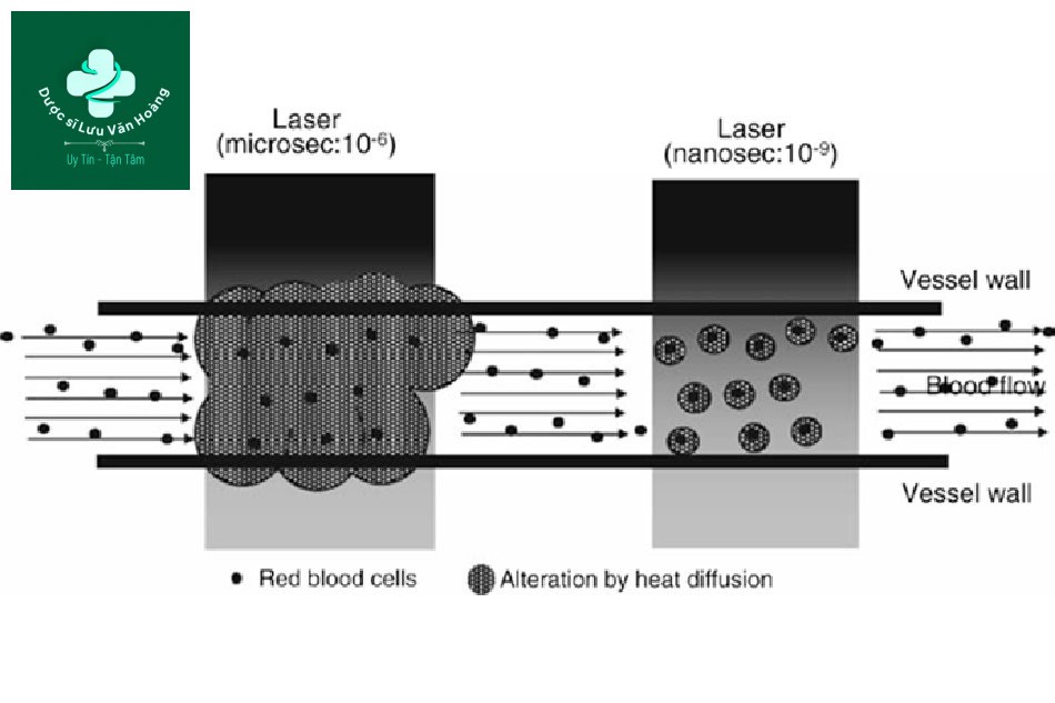 Một sơ đồ cho thấy sự khác biệt trong việc điều trị các tổn thương mạch máu giữa laser xung dài (micro giây) và ngắn (nano giây). 