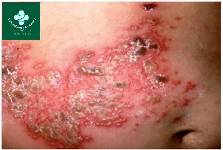 HÌNH 2.10 Herpes zoster – sự tái hoạt của virus varicella-zoster trong các hạch thần kinh cảm giác dẫn đến phát ban da, mụn nước, đau.