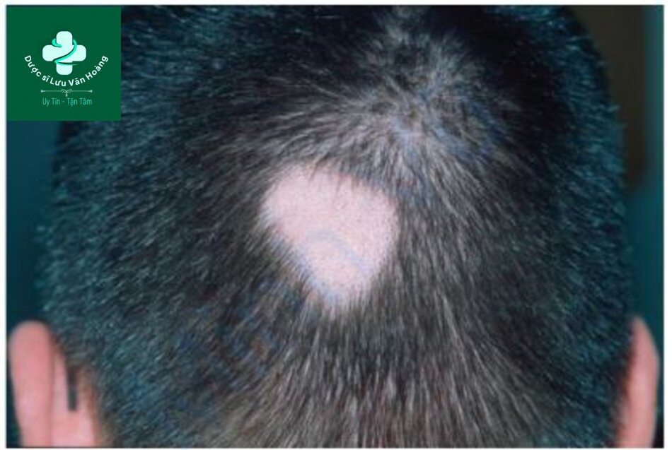 HÌNH 2.12 Rụng tóc từng vùng – tình trạng tự miễn dẫn đến các mảng rụng tóc hình tròn không để lại sẹo.