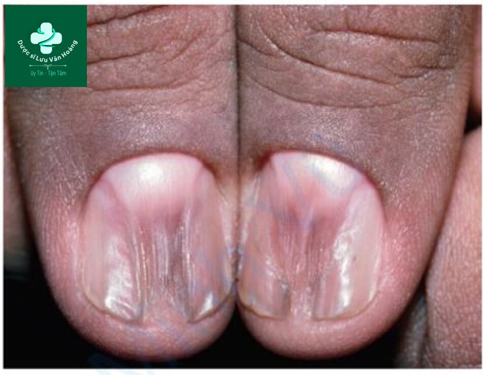 HÌNH 2.15 Lichen phẳng – một tình trạng viêm thường ảnh hưởng đến da và niêm mạc, nhưng có thể ảnh hưởng đến chất nền của móng và gây ra tình trạng móng bị loạn dưỡng.