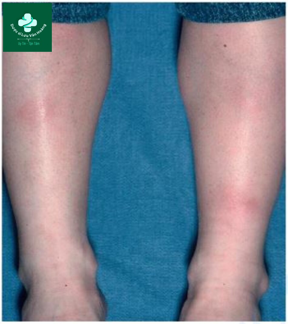 HÌNH 2.16 Hồng ban nút. Các nốt dưới da thường thấy nhất ở cẳng chân của phụ nữ sau khi bắt đầu dùng thuốc tránh thai do tình trạng viêm tập trungở vách xơ ngăn cách các tế bào mỡ hoặc tiểu thùy mỡ.