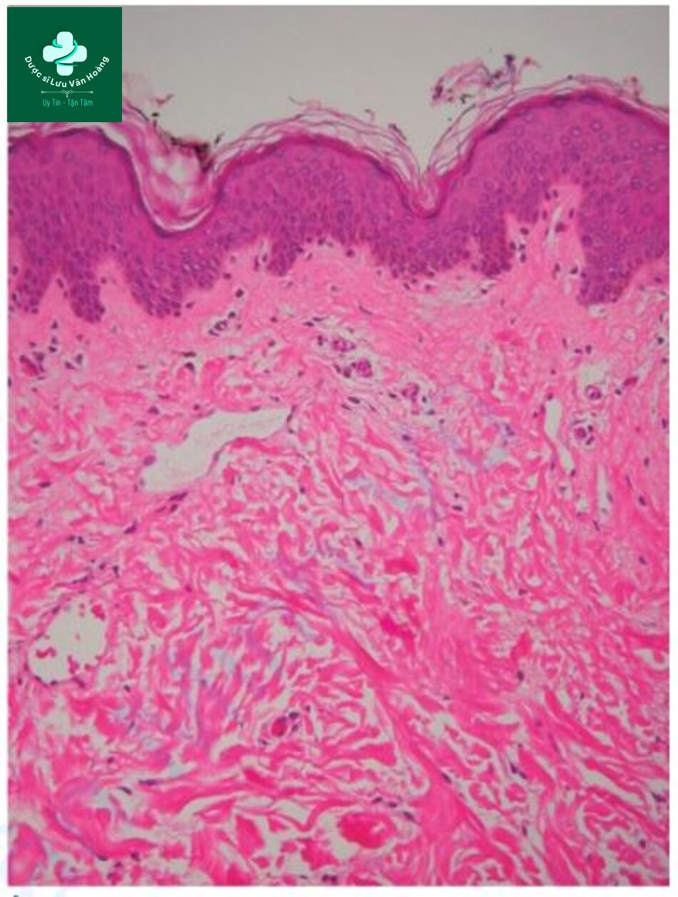 HÌNH 2.8Lớp bì nhú – các sợi collagenmảnh và lỏng lẻo. Lớp bì lưới – các sợi collagen dày và đặc.