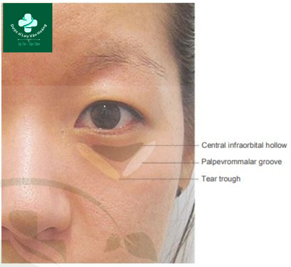Fig. 4.32 Infraorbital hollowness consists of three parts depending on the location, namely the tear trough on the medial aspect, the central infraorbital hollow on the central aspect, and the palpebromalar groove on the lateral aspect