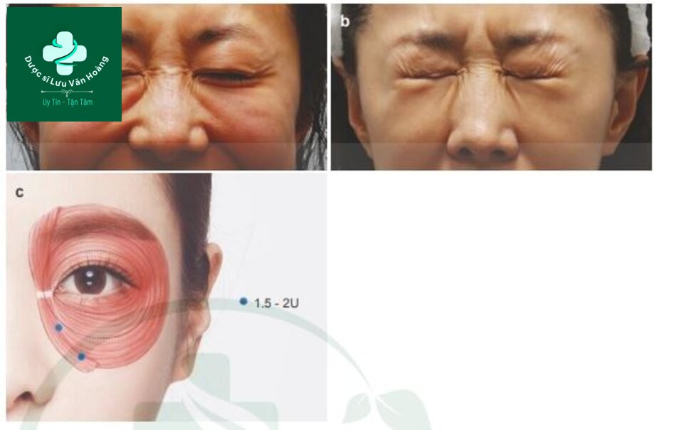  Fig. 4.38 Sử dụng botox để điều trị phì đại giải trung tâm cơ vòng mắt (a) Before, (b) afterand (c). điểm tiêm cho phì đại giải trung tâm cơ vòng mắt