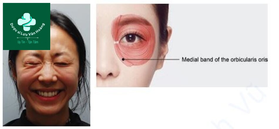 Hình 1.12 Dải giữa phì đại của cơ vòng mắt (a) Sự co lại của dải giữa phì đại của cơ vòng mắt (b) Giải phẫu dải giữa phì đại của cơ vòng mắt