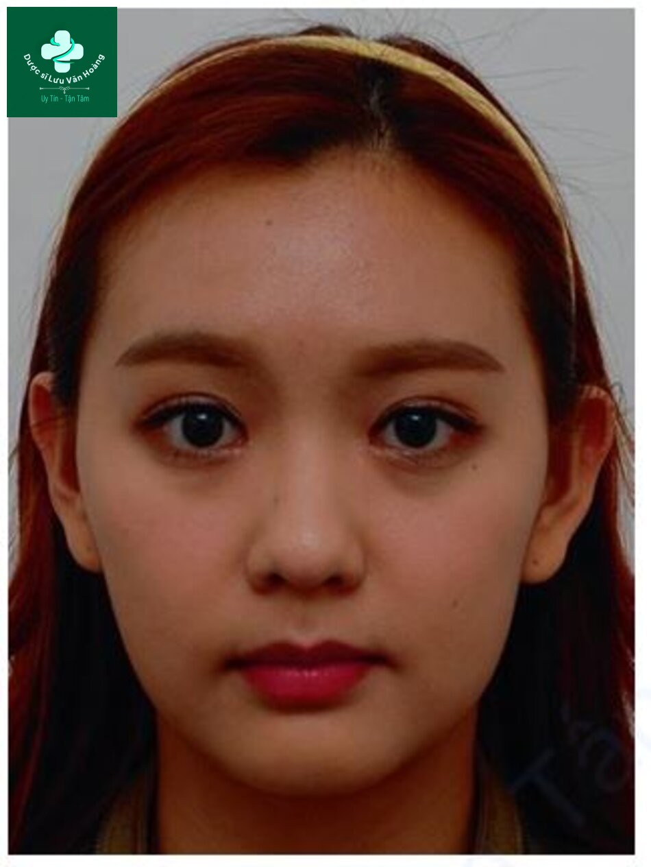 Hình 1.18 Một cá nhân có thể biểu hiện các đặc điểm hình thái khác nhau ở các phần riêng biệt của khuôn mặt. Người phụ nữ Hàn Quốc xinh đẹp này thể hiện một số đặc điểm kiểu phương Nam như nếp mí mắt và khe mắt rộng nhưng cũng thể hiện các đặc điểm kiểu người phương Bắc như gò má nổi bật, khuôn mặt rộng và phần mũi hẹp.