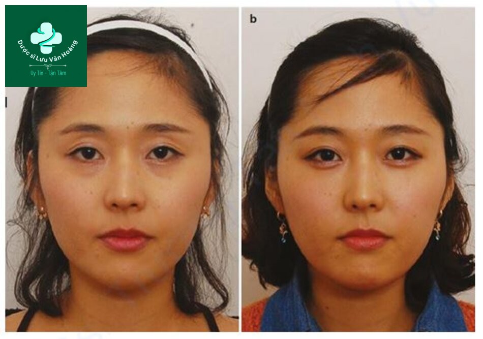 Hình 1.25 (a) Trước và (b) sau khi nâng mũi trước và sau khi nâng mũi kết hợp với bơm chất làm đầy cho mắt trũng và rãnh lệ
