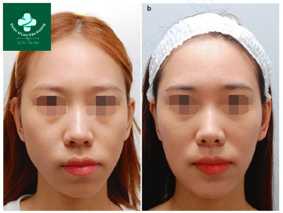  Hình 1.7 Sự bất đối xứng trên khuôn mặt có thể được hưởng lợi từ việc cải thiện thẩm mỹ bằng cách sử dụng chất làm đầy dạng tiêm. (a) Trước và (b) sau khi làm đầy