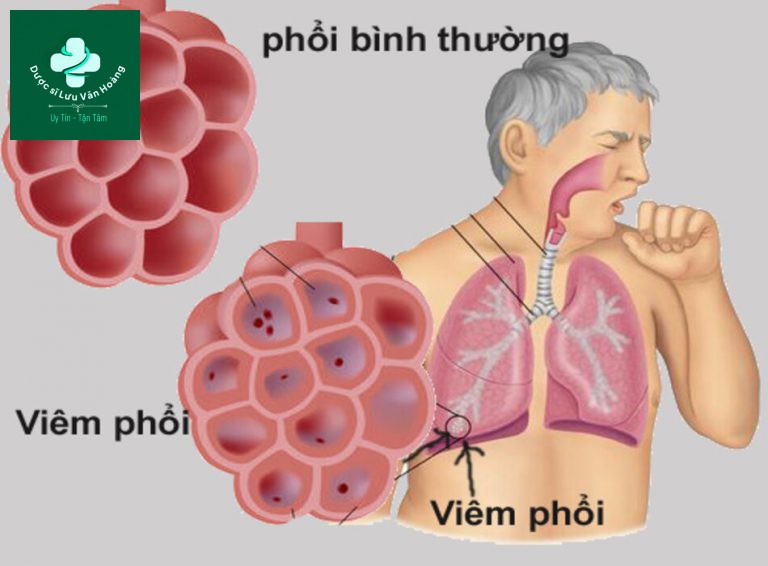 Hướng dẫn chẩn đoán và điều trị viêm phổi