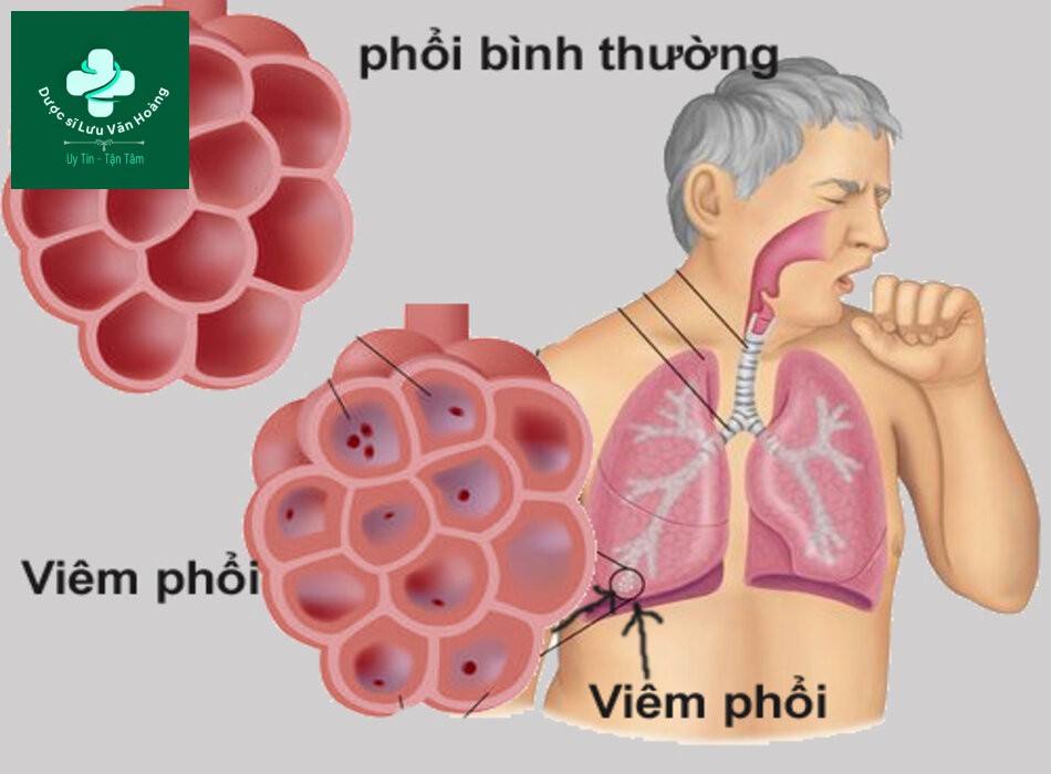 Hướng dẫn chẩn đoán và điều trị viêm phổi