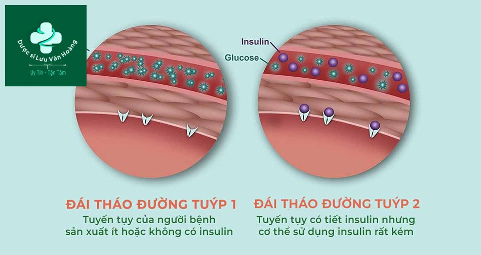 Bệnh tiểu đường gồm 2 thể chính là tiểu đường tuýp 1 và tiểu đường tuýp 2.