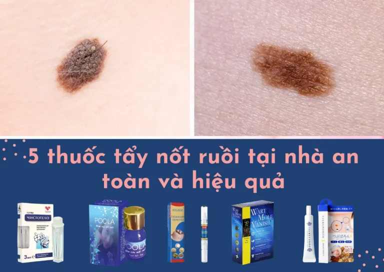 5 thuốc tẩy nốt ruồi tại nhà an toàn và hiệu quả