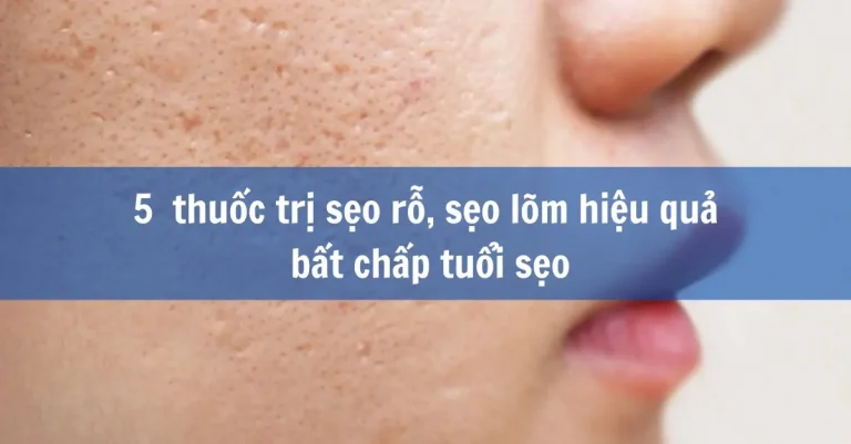 5 thuốc trị sẹo lõm hiệu quả bất chấp tuổi sẹo