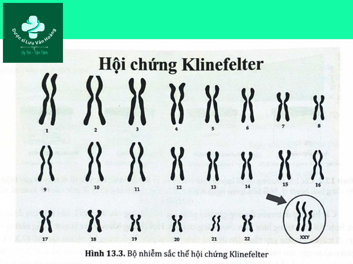 Hình 13.3. Bộ nhiễm sắc thể hội chứng Klinefelter