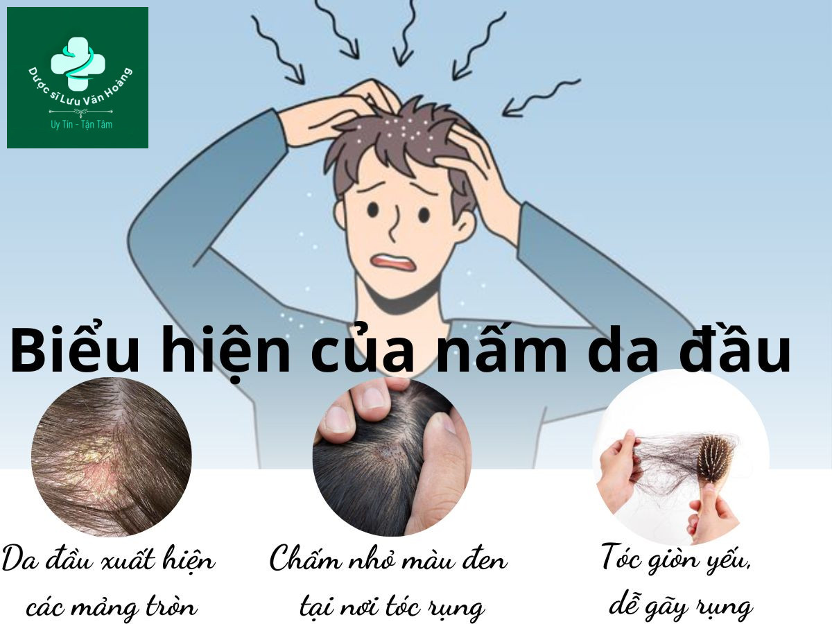 Dấu hiệu của bệnh nấm da đầu