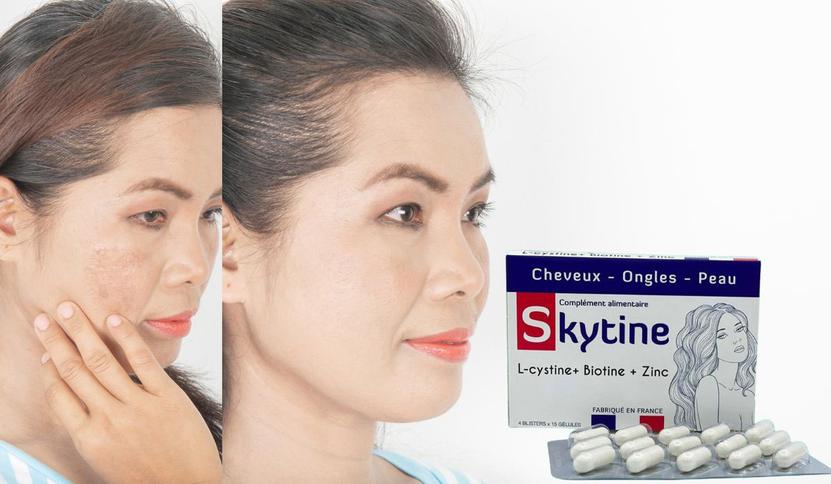 Skytine giúp giảm sạm, nám trên da