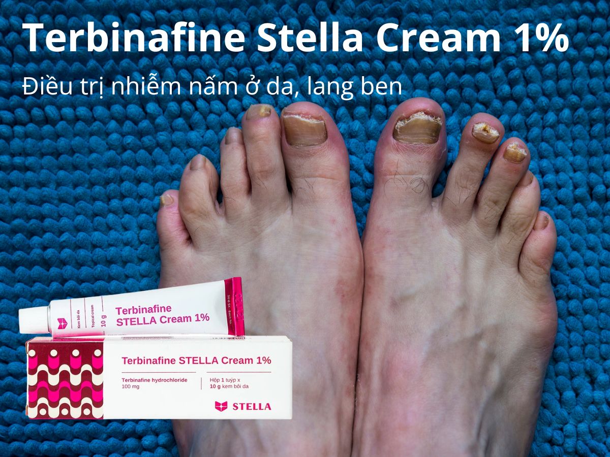 Terbinafine Stella Cream 1% 18 Terbinafine Stella Cream 1%