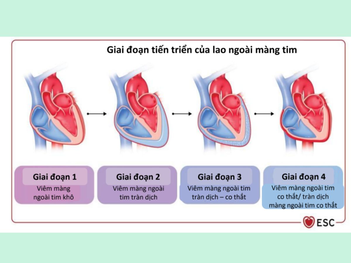 Các giai đoạn tiến triển của lao ngoài màng tim