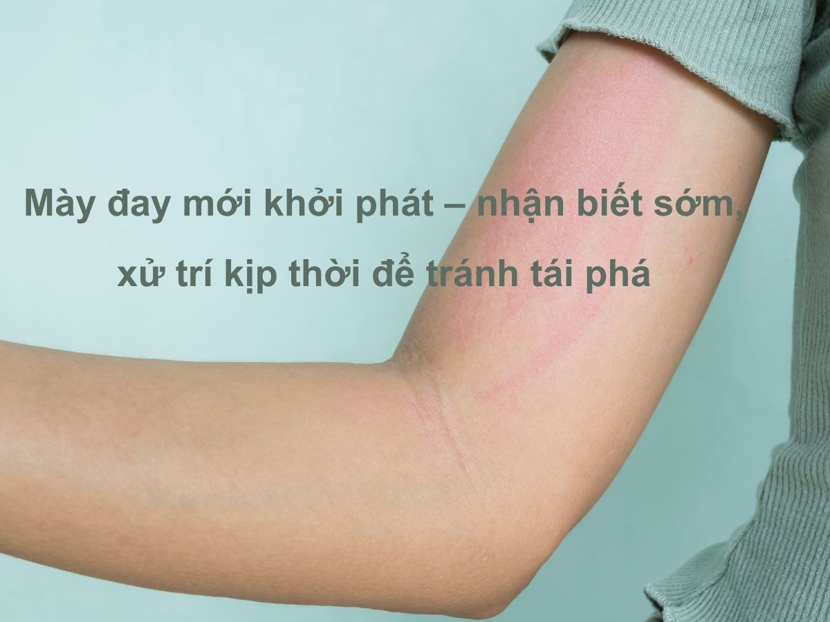 Mày đay mới khởi phát