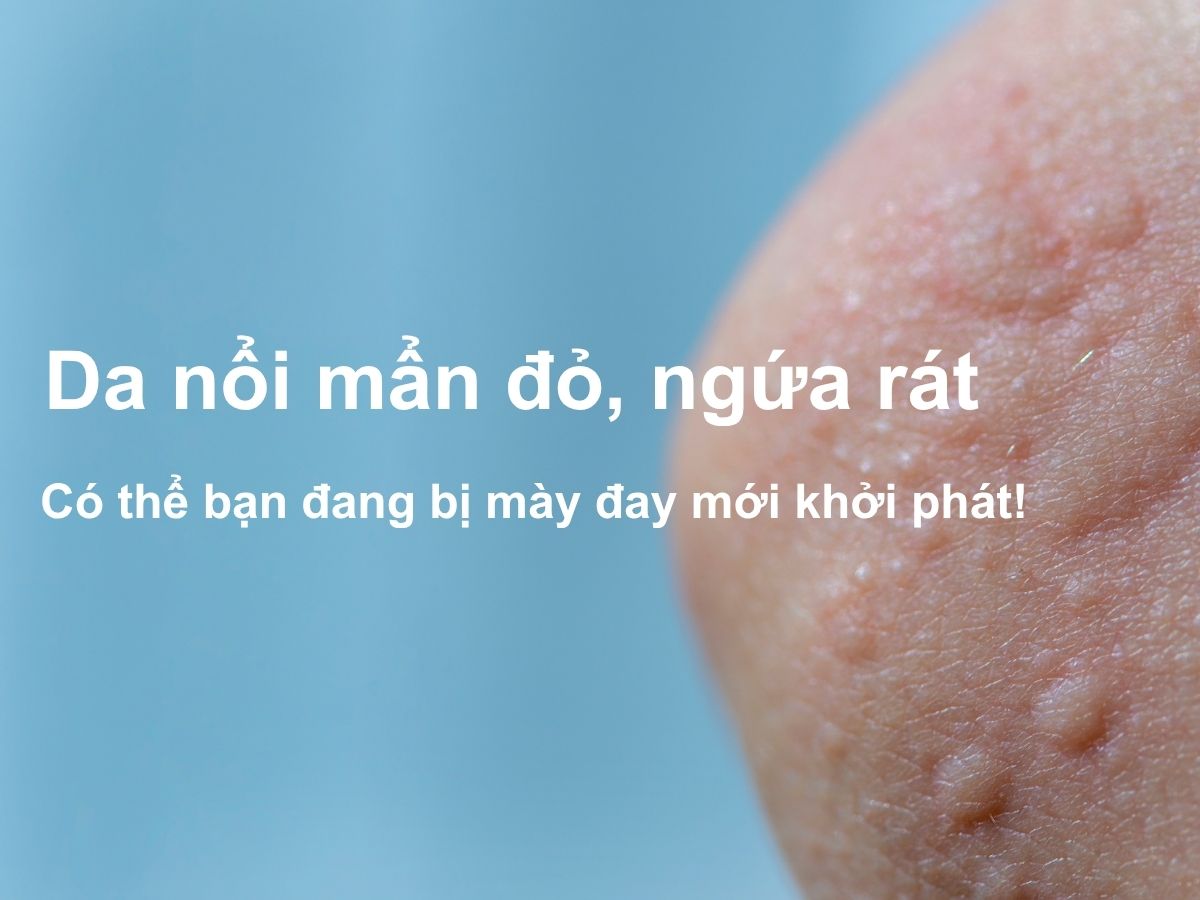 Mày đay mới khởi phát
