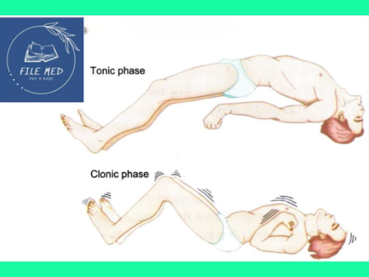 Tìm hiểu về cơn động kinh và động kinh - Định nghĩa, nguyên nhân 6 Cơn động kinh và động kinh