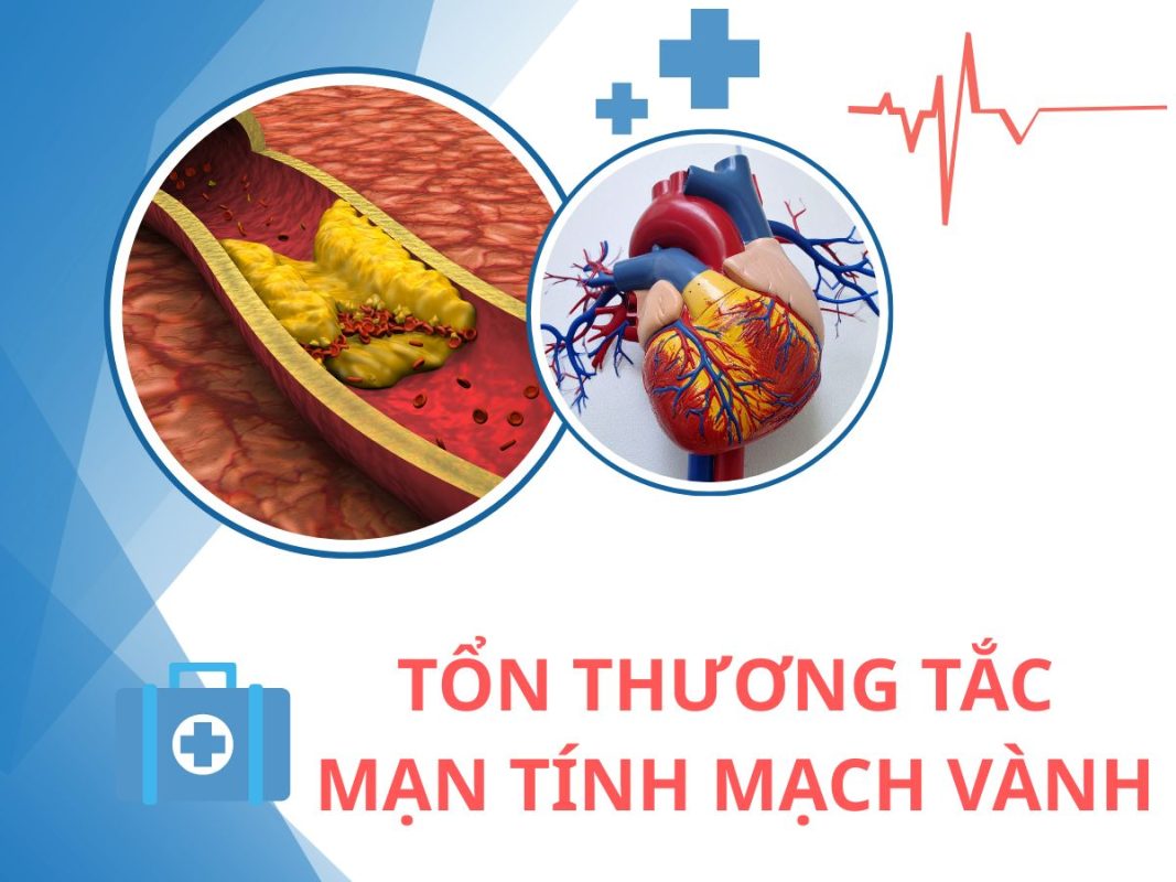 Điều trị tổn thương tắc mạn tính mạch vành