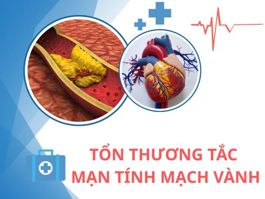 Điều trị tổn thương tắc mạn tính mạch vành