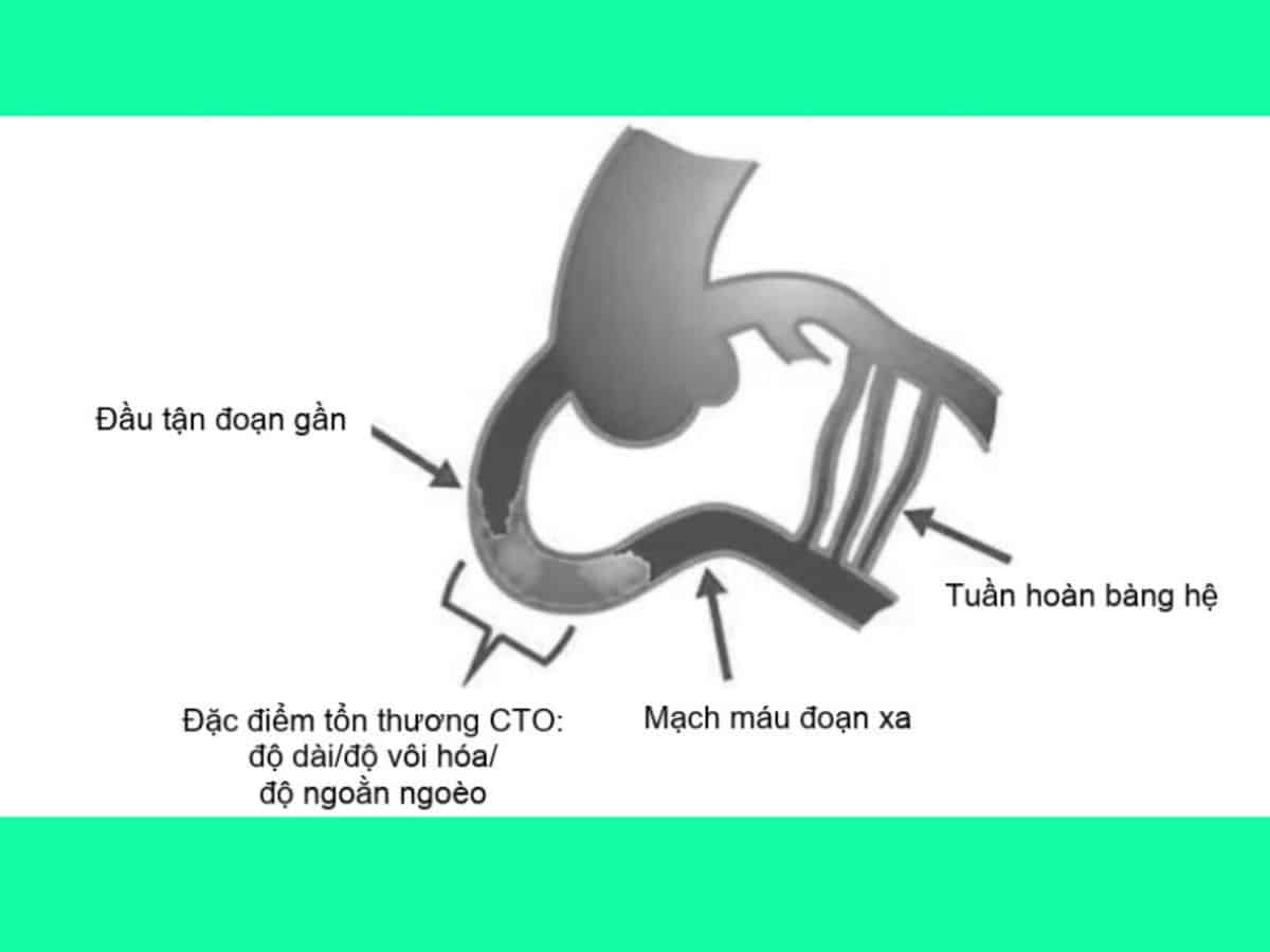 Hình 3. Các thông số hình ảnh chính cần đánh giá trước khi can thiệp CTO.