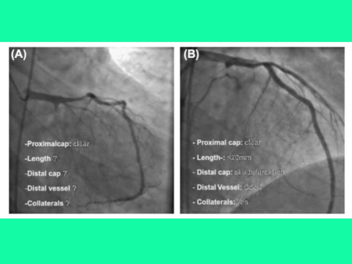 Hình 4. Ví dụ về vai trò của bơm cản quang kép khi can thiệp CTO nhánh mũ. (A): Chỉ bơm cản quang vào thân chung; (B): Bơm cản quang kép vào thân chung và động mạch vành phải.