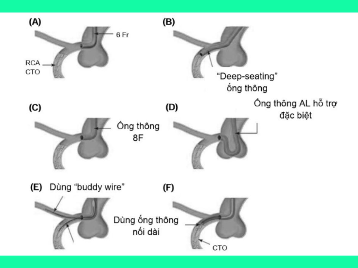 Hình 5. Các kỹ thuật tăng lực hỗ trợ cho guiding catheter.